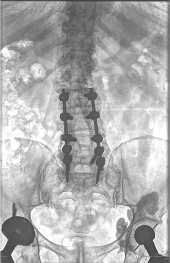 Radiografía cadera